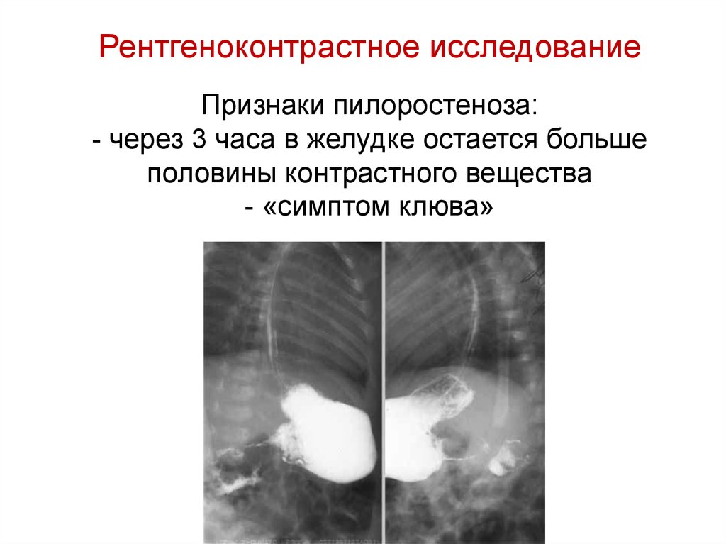 Пилоростеноз врожденный презентация