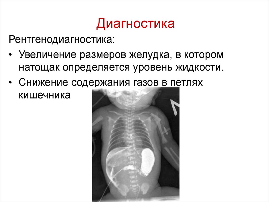 Пилоростеноз у детей презентация