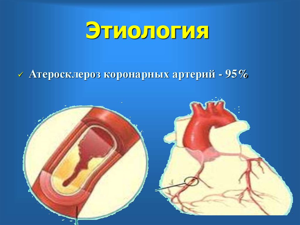 Артерий атеросклероз латынь. Атеросклероз коронарных артерий факторы риска. Этиология атеросклероза коронарных артерий. Атеросклероз коронарных артерий патогенез. Стадии атеросклероза коронарных артерий.