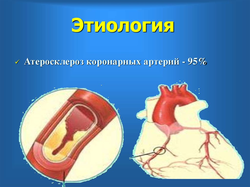 Артерий атеросклероз латынь