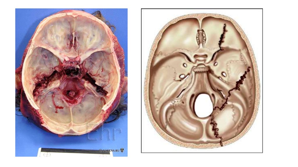 Бас сүйегінің негізінің сыныу