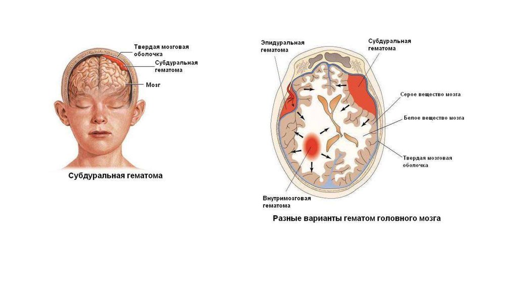 Бас сүйегінің жарақаттарында мида гематомалар пайда болуы мүмкін