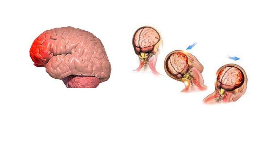 Мидың мыжылуы (ушиб головного мозга).