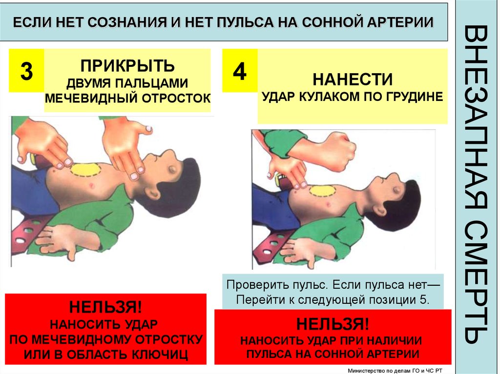 Наличие пульса на сонной артерии. Если нет сознания и нет пульса. Если нет сознания и пульса на сонной артерии. Сердечно легочной реанимации удар по грудине и приступить.