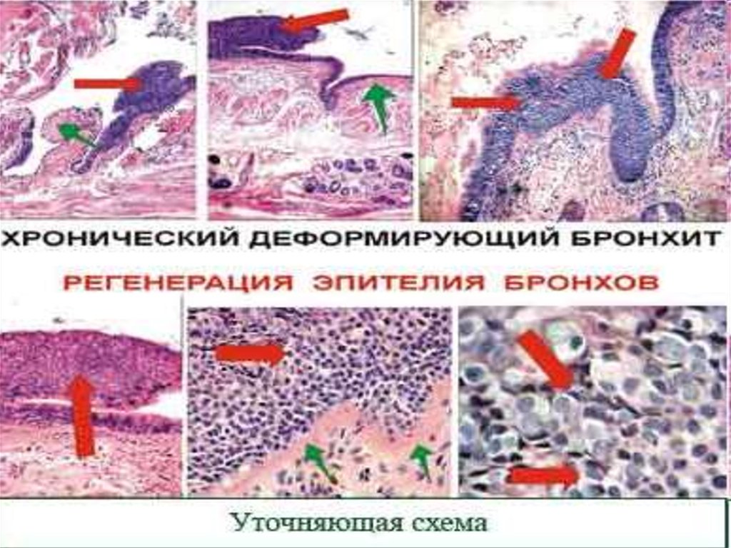 5 хронический бронхит. Хронический полипозный бронхит микропрепарат. Хронический бронхит микропрепарат. Хронический деформирующий бронхит микропрепарат. Полипозный хронический бронхит это патанатомия.