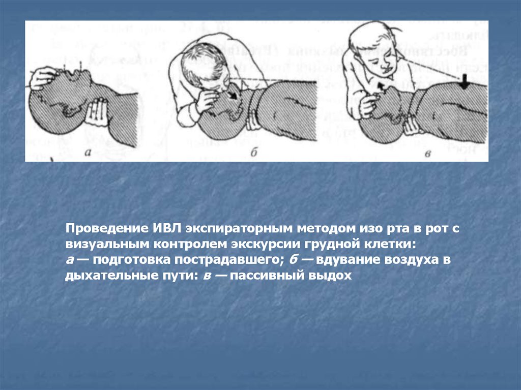 Проведение искусственной вентиляции. Проведение ИВЛ экспираторным методом. Проведение ИВЛ методом «изо рта в нос».