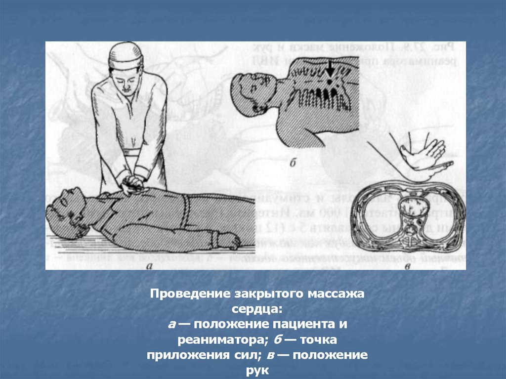 Закрыть массаж сердца. Проведение закрытого массажа сердца. Осуществление закрытого массажа сердца. При проведении закрытого массажа сердца. Закрытый массаж сердца алгоритм.