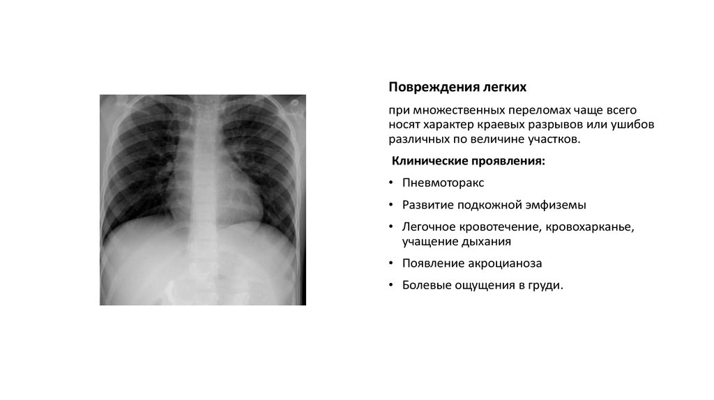 Ранение легкого. Симптомы повреждения легких. Подкожная эмфизема грудной клетки рентген описание. Разрыв легкого рентген признаки. Признак повреждения легкого.