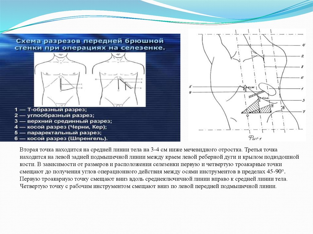 Операции на селезенке