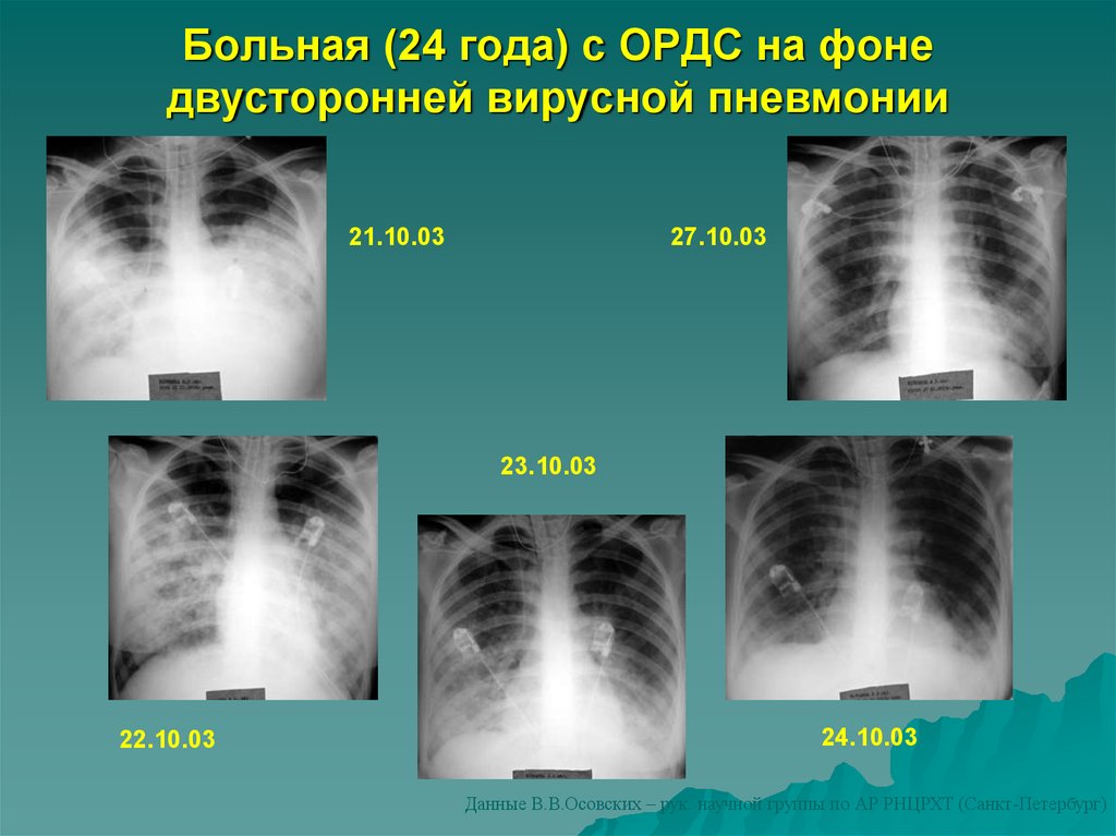 Уплотнение легкого при ордс связано