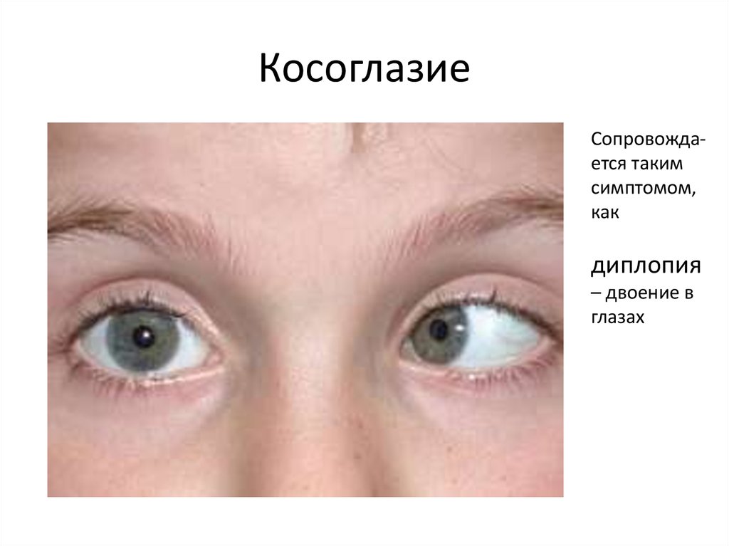 Жалобы на двоение в глазах. Косоглазие. Косоглазие глаза. Нарушение зрения диплопия.