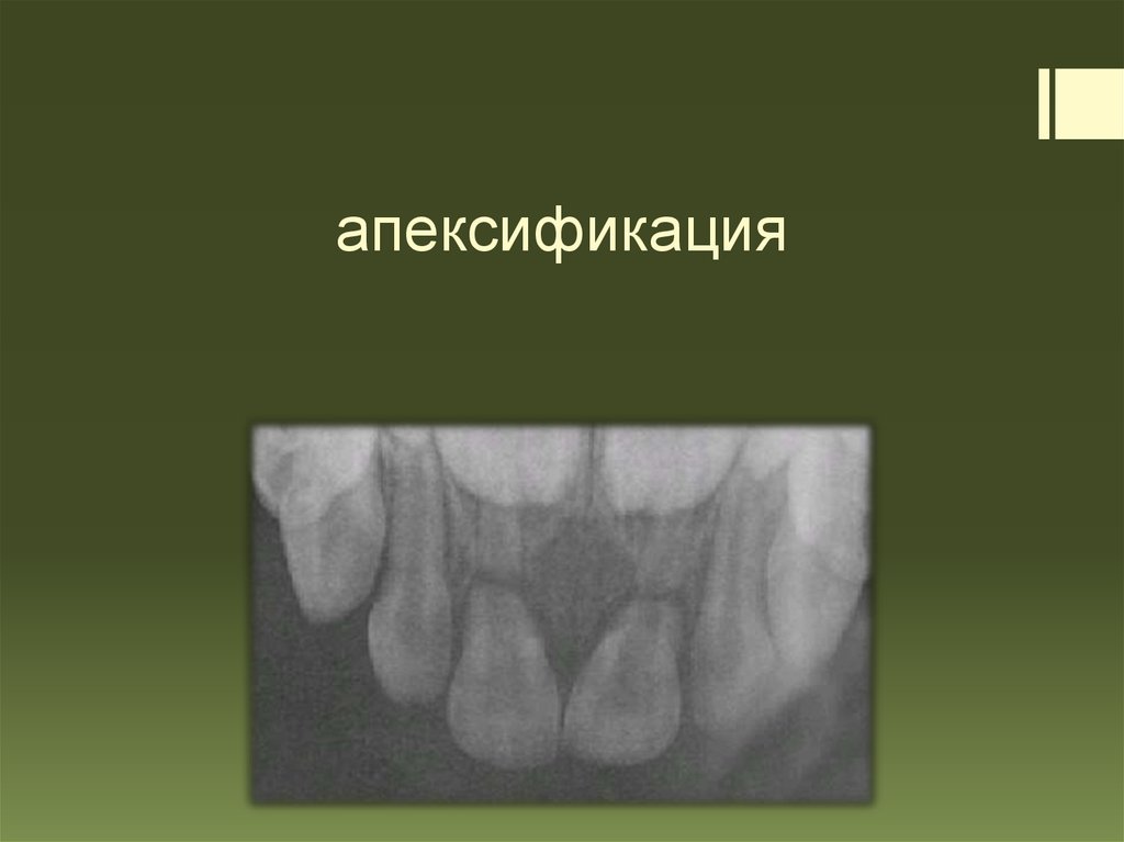 Апексогенез и апексификация презентация