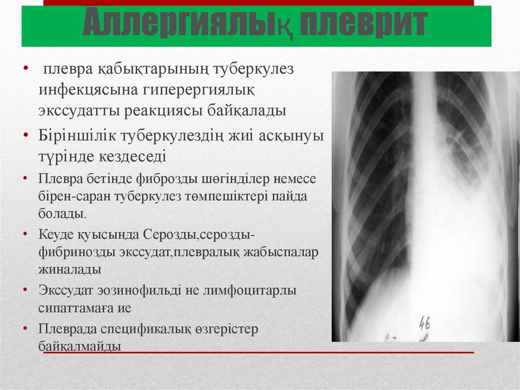 Сухой плеврит рентгенологическая картина