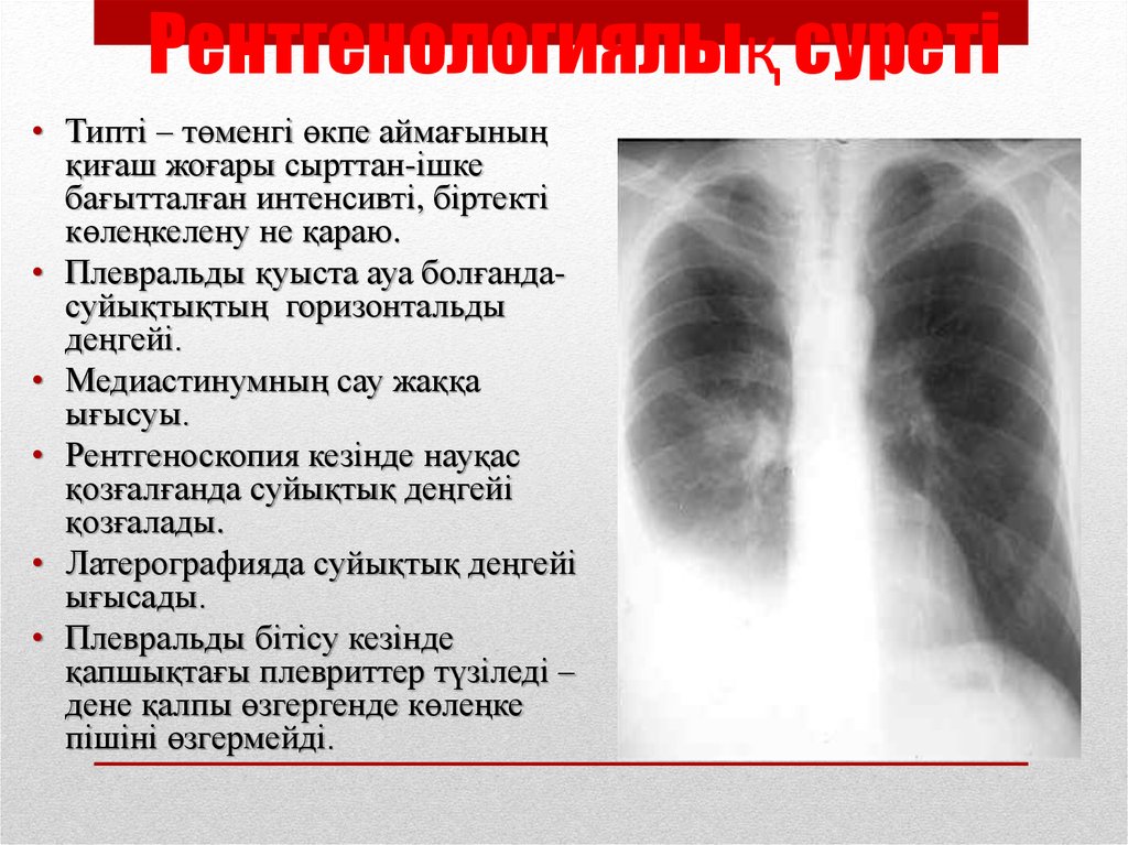 Рентгенологиялық суреті