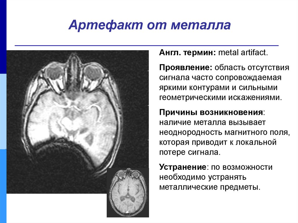 Артефакты дыхания. Артефакты от металла на мрт. Металлический артефакт на мрт. Артефакты на кт. Артефакты мрт изображений.