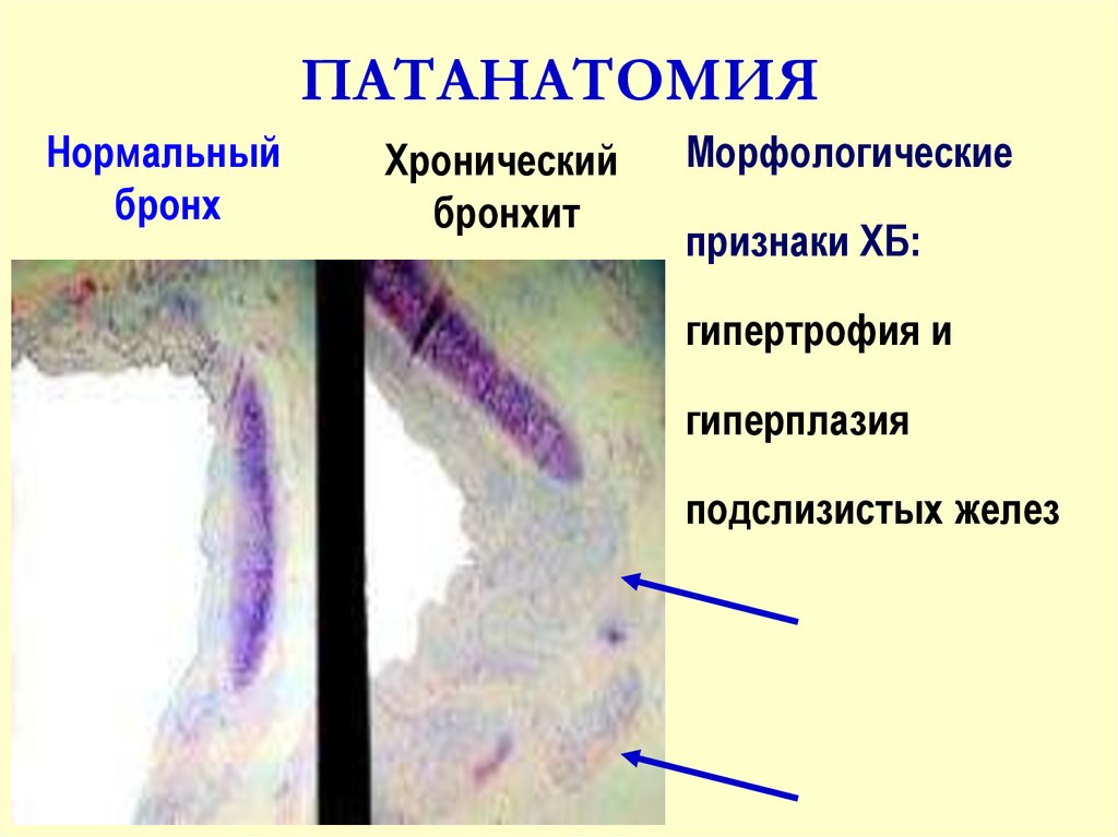 Ревматизм патанатомия презентация