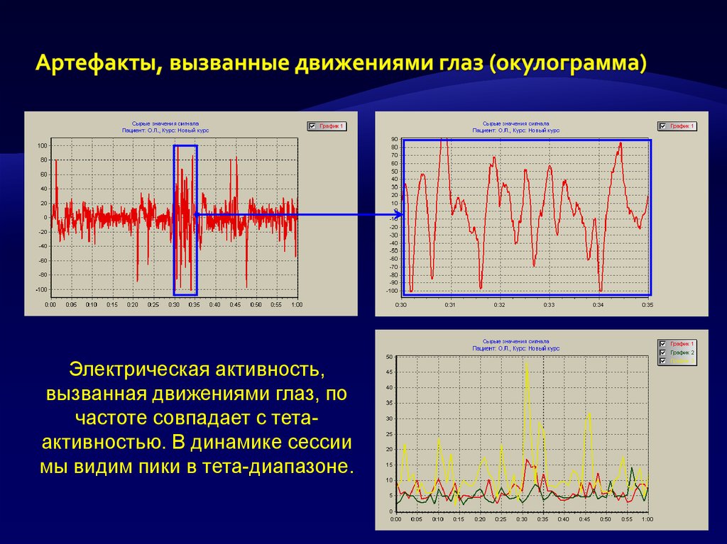 Вызванная активность. Артефакты движения глаз на ЭЭГ. Артефакты ЭЭГ при движении глаз. Электроокулографические артефакты. Артефакты ЭКГ при движении глаз.