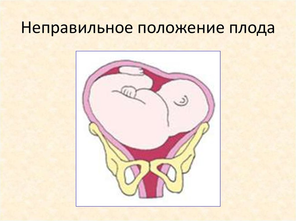 Косое и поперечное положение плода презентация