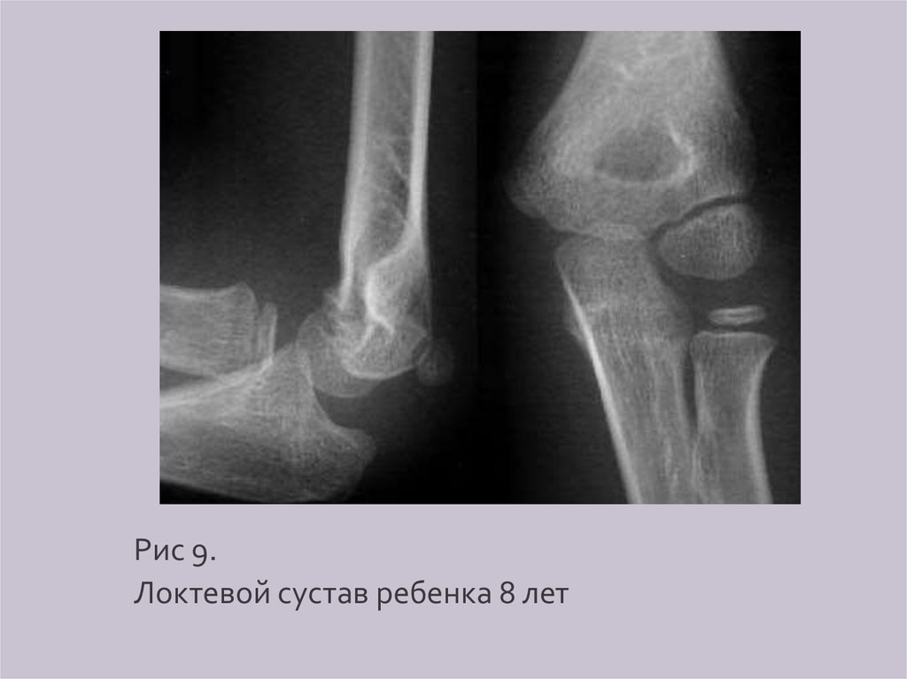 Локтевой сустав рентген. Локтевой сустав рентген анатомия у детей. Локтевой сустав ребенка 8 лет рентген. Норма рентген локтевой сустав 2 года. Рентген локтя ребёнок 8 лет.