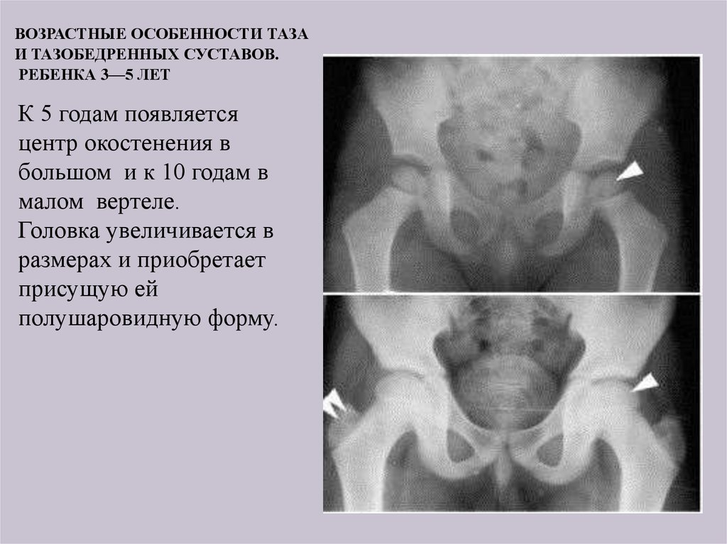 Изменения костей таза. Аплазия тазобедренного сустава новорожденных. Ядра окостенения тазобедренного сустава возрастные. Возрастные изменения костного таза. Ядра окостенения костей таза.