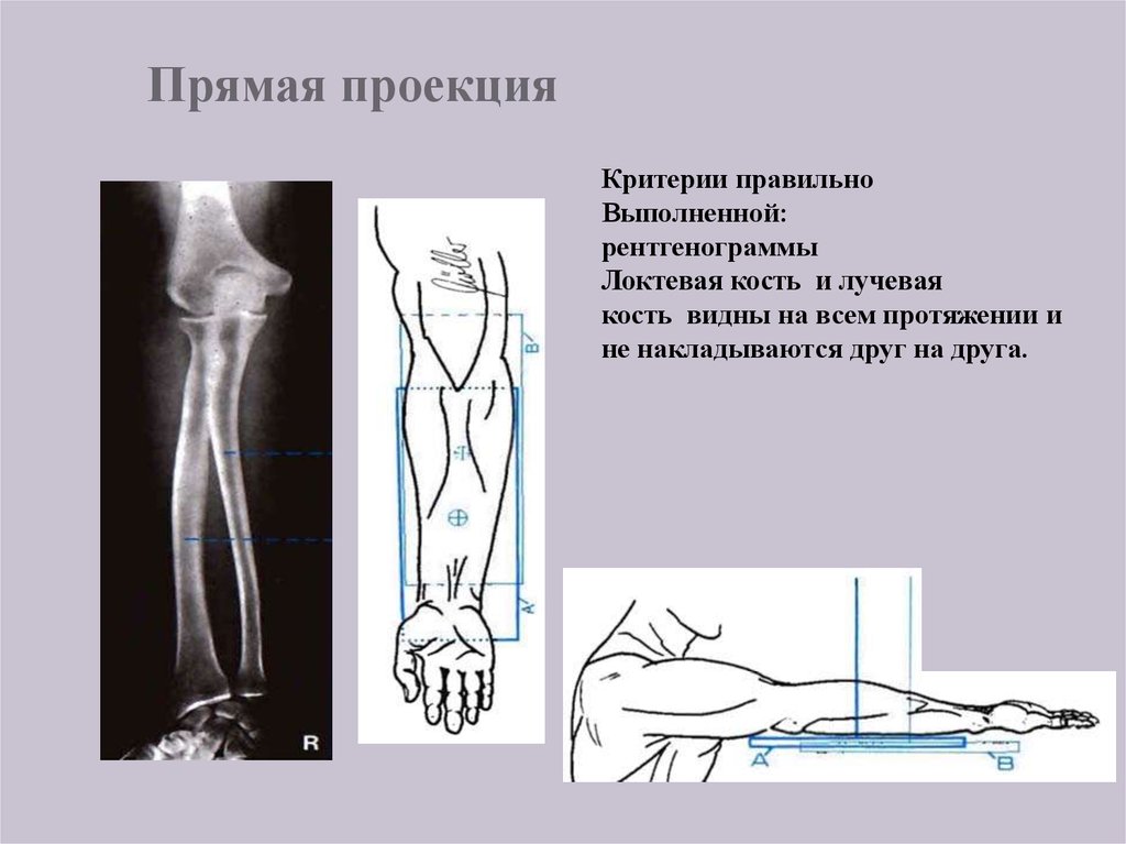 Проекция костей