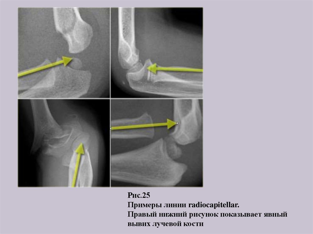 Головка лучевой кости. Вывих головки лучевой кости. Вывих локтевой кости рентген. Подвывих головки лучевой кости рентген. Подвывих локтевого сустава рентген.