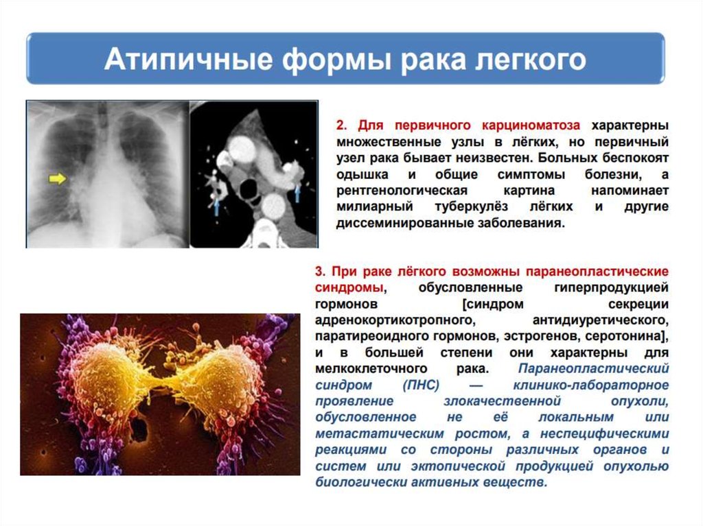 Рак легкого презентация