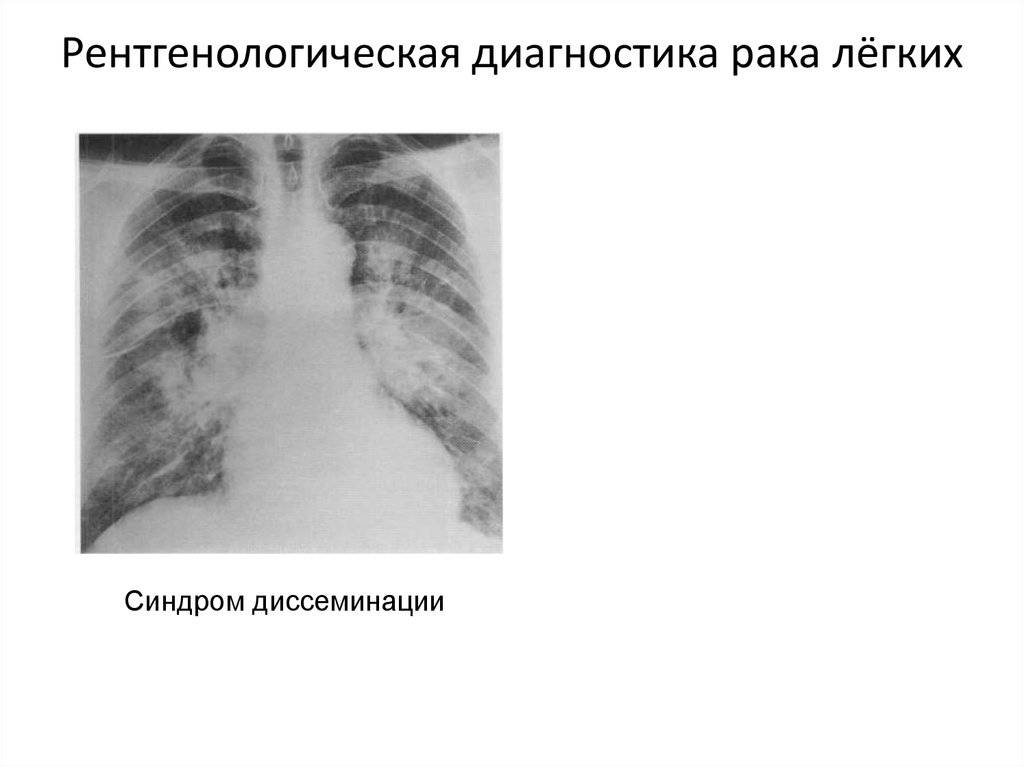 Диагностика легких. Рентгенологический синдром диссеминации. Синдром диссеминации в легких рентген. Синдром диссеминации рентген. Диагноз онкологии легких.