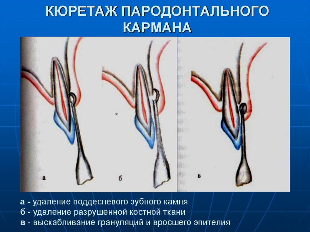 Общие принципы пародонтальной хирургии презентация