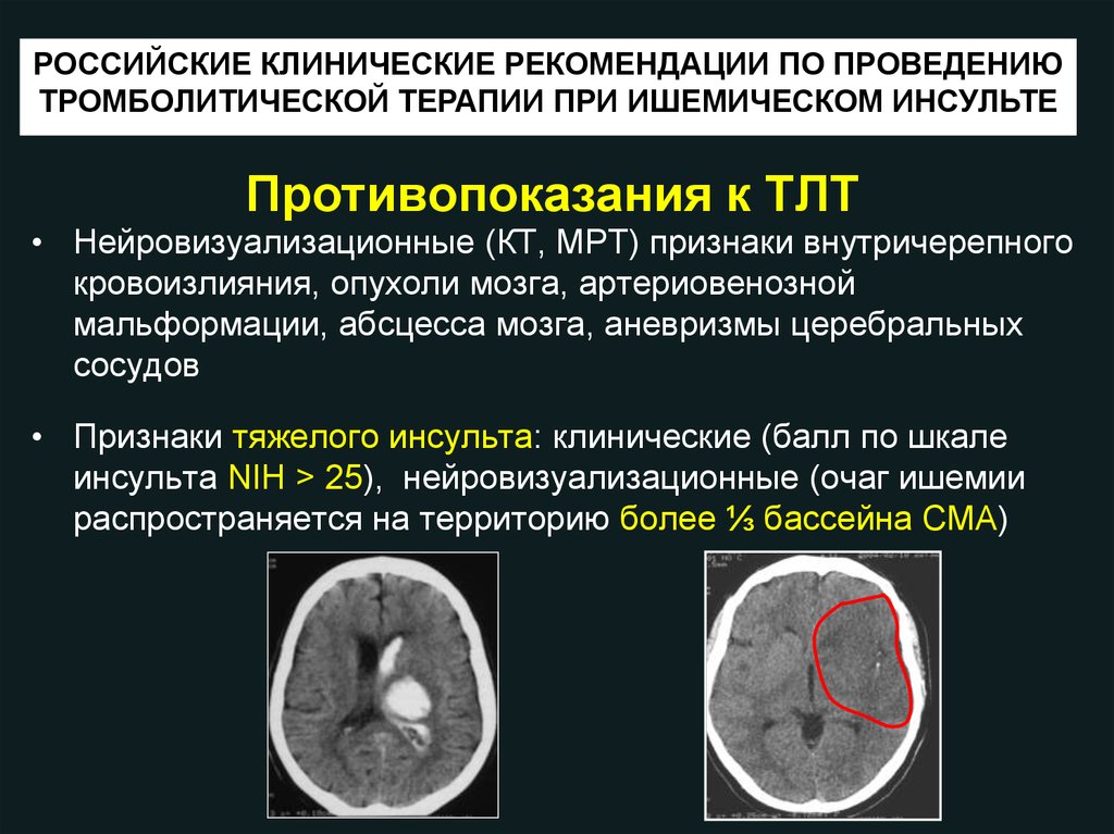 Что такое ишемический инсульт головного мозга