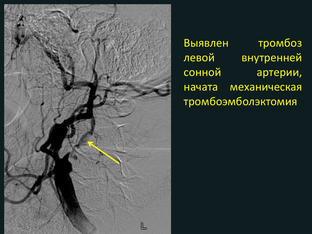 Изгиб вса. Неполная трифуркация левой внутренней сонной артерии. Тромбоз внутренней сонной артерии кт. УЗИ тромбоз внутренней сонной артерии.