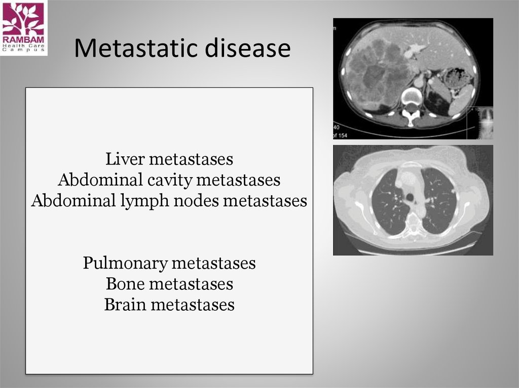 Metastatic disease