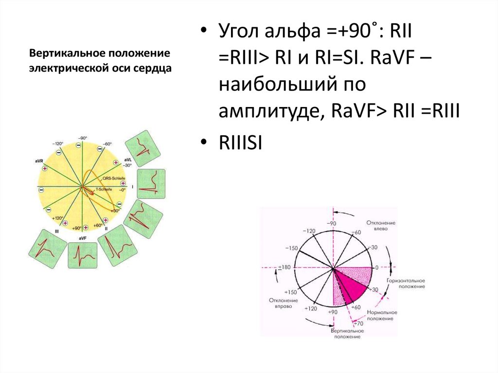 Вертикальная эос. Угол Альфа при r1=s1. Угол Альфа при r1 s1 равен. Вертикальное положение электрической оси сердца. Вертикальная электрическая ось сердца на ЭКГ.