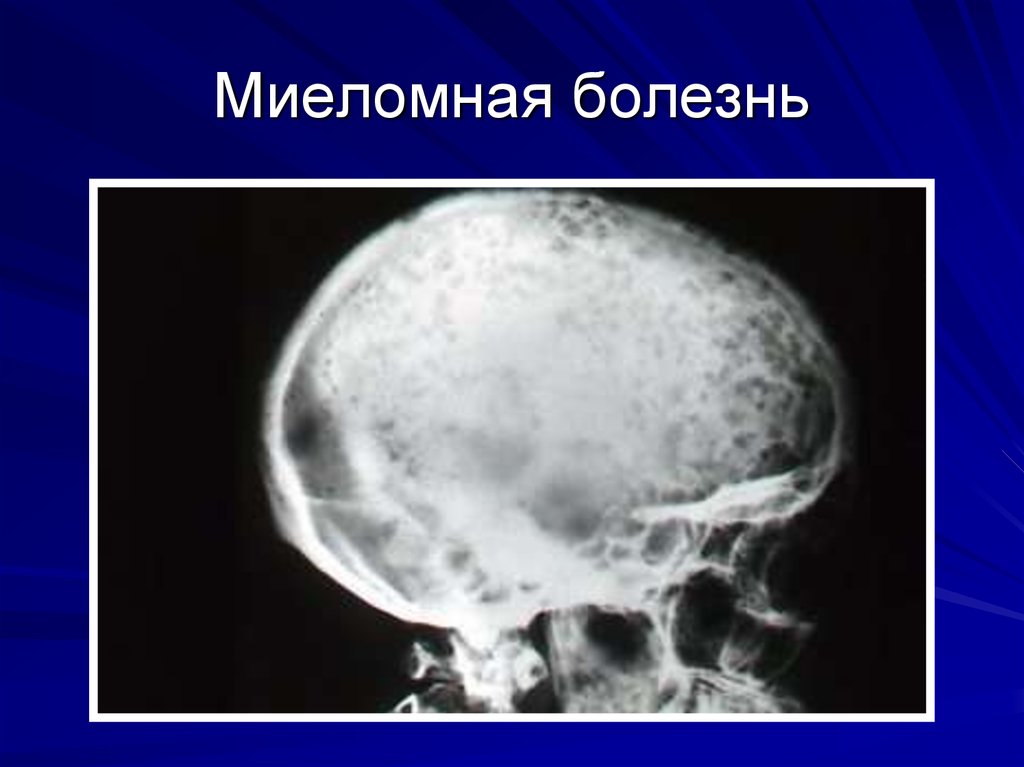 Миеломная болезнь что. Множественная миелома рентген черепа. Миеломная болезнь костей черепа. Рентген черепа при миеломной болезни. Миеломная болезнь рентген черепа.