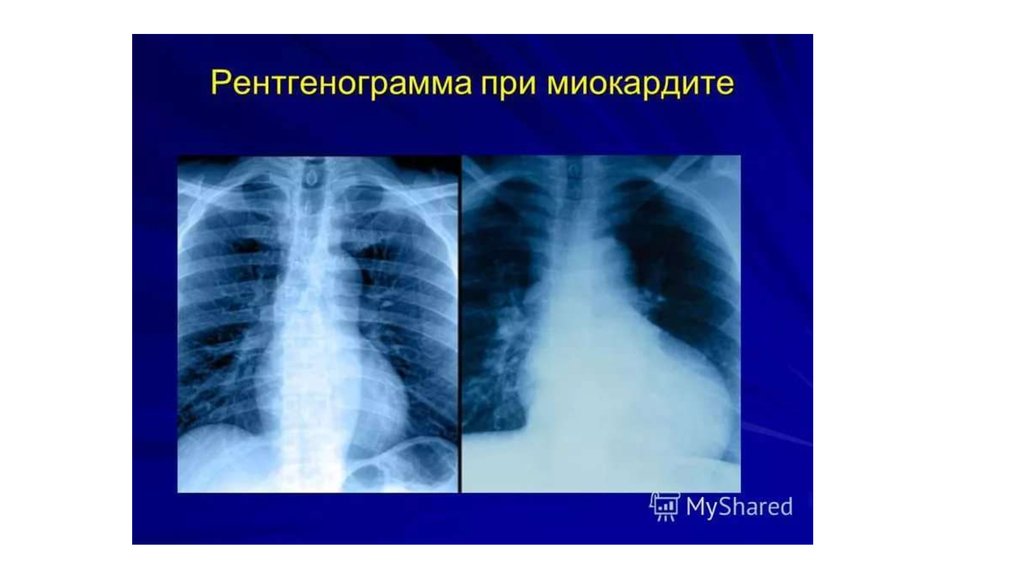 Миокардит у детей презентация