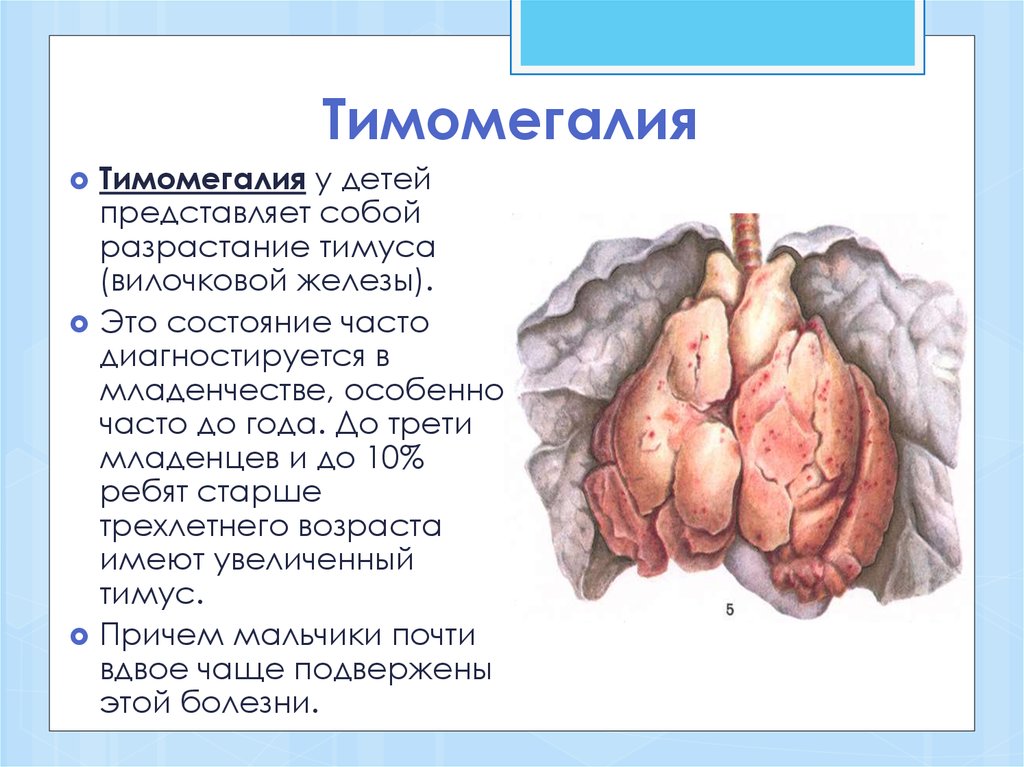 Как вылечить тимомегалию у детей