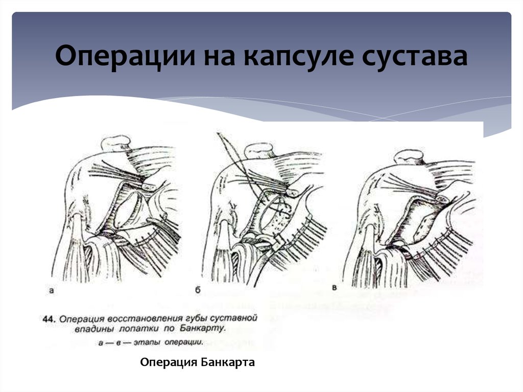 Операция на плечевом суставе