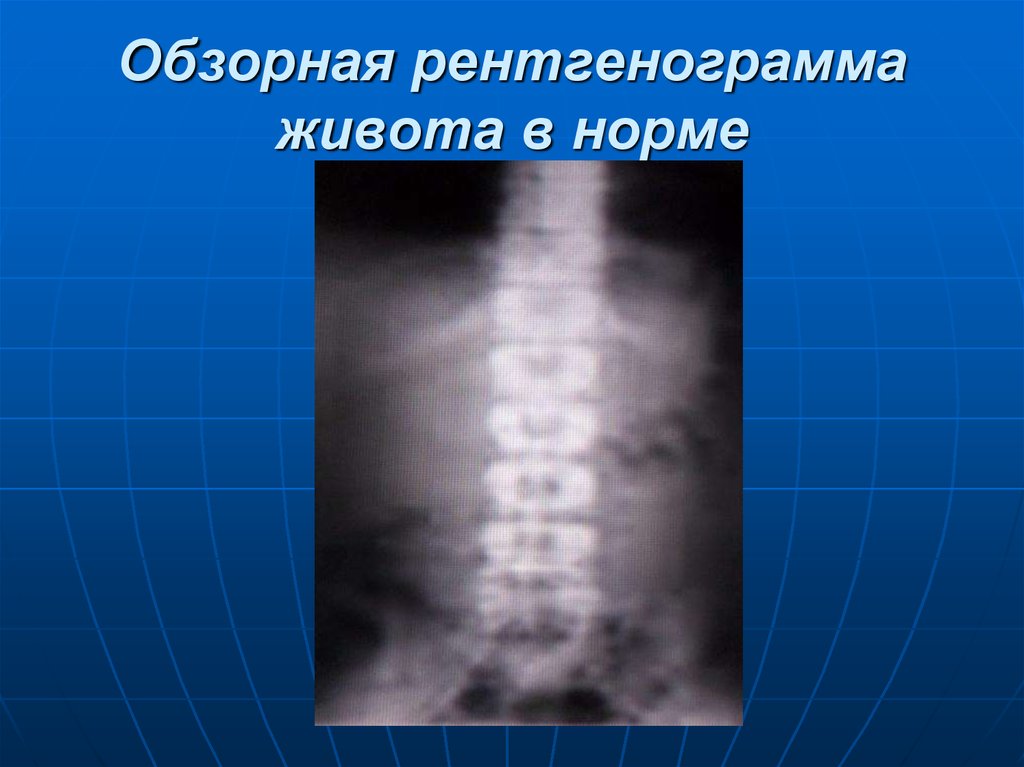 Обзорная рентгенография. Обзорная рентгенограмма живота. Рентгенограмма живота норма. Обзорная рентгенография живота в норме.