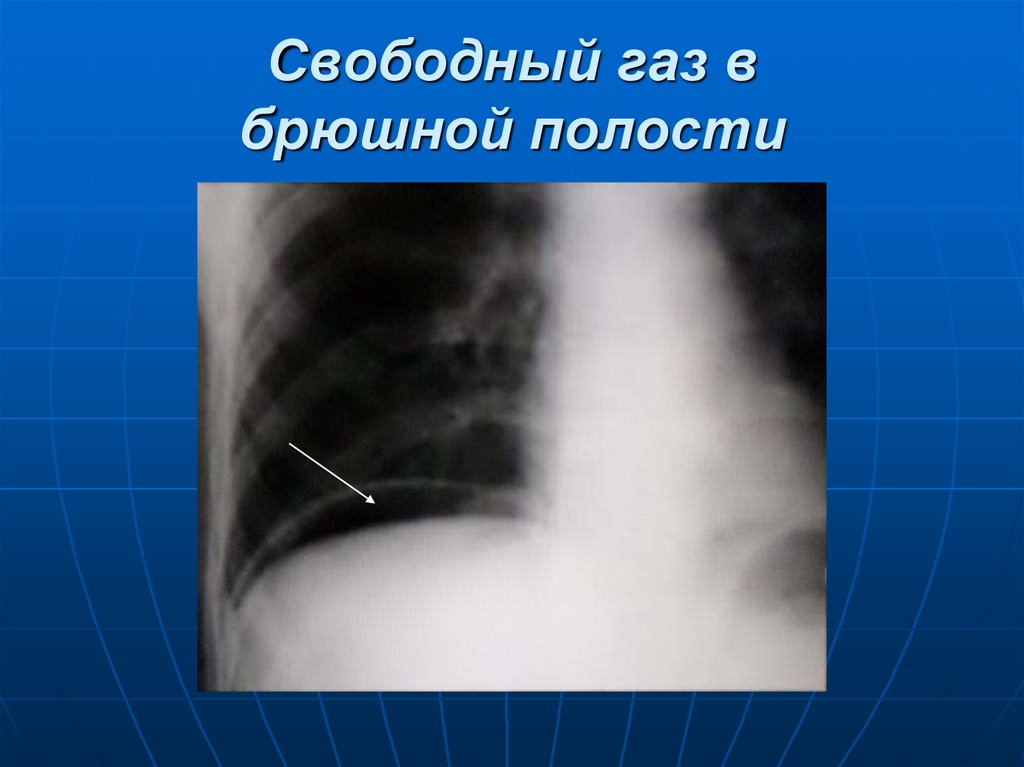 Свободный газ. Прободная язва желудка рентген. Перфоративная язва желудка рентген. Рентгенография перфорации язвы желудка. Перфорация желудка рентген.