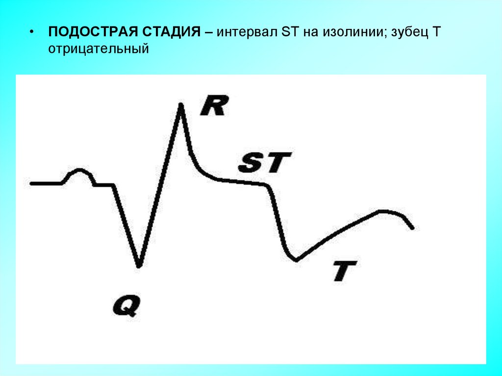 Эх анализ. Зубец St на изолинии. Зубец т выше изолинии. Интервал St на изолинии. Отрицательный зубец т.