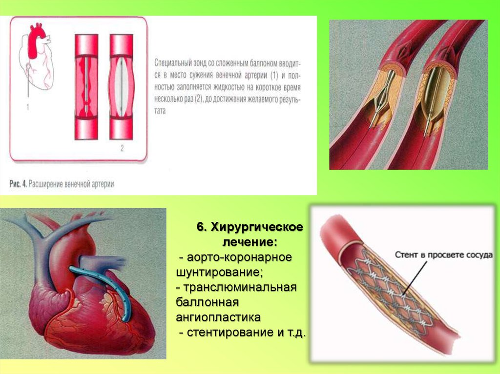Что такое шунтирование сердца и сосудов. ТРАНСЛЮМИНАЛЬНАЯ баллонная ангиопластика. Шунтирование коронарных артерий. ТРАНСЛЮМИНАЛЬНАЯ ангиопластика коронарных артерий. Баллонная ангиопластика при ИБС.