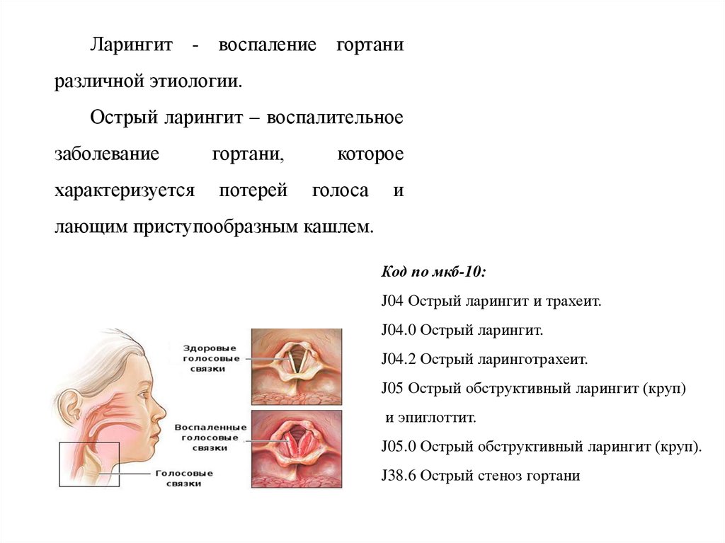 Острый ларингит и трахеит (дети, стационар)