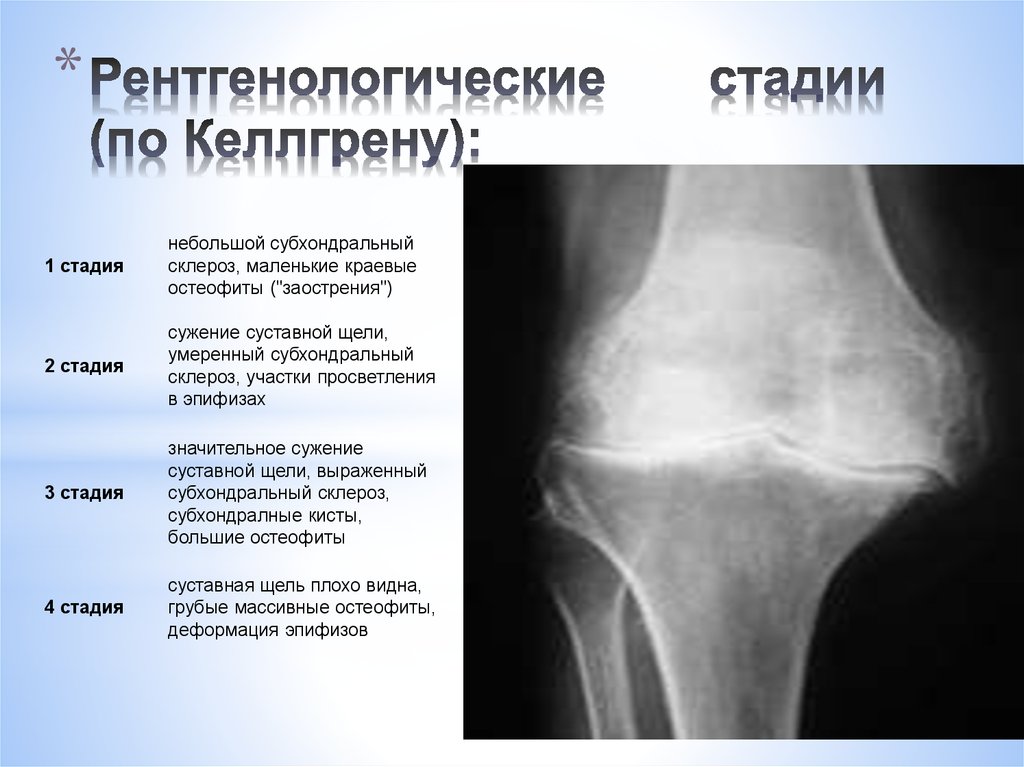 Рентгенологическая картина остеоартроза