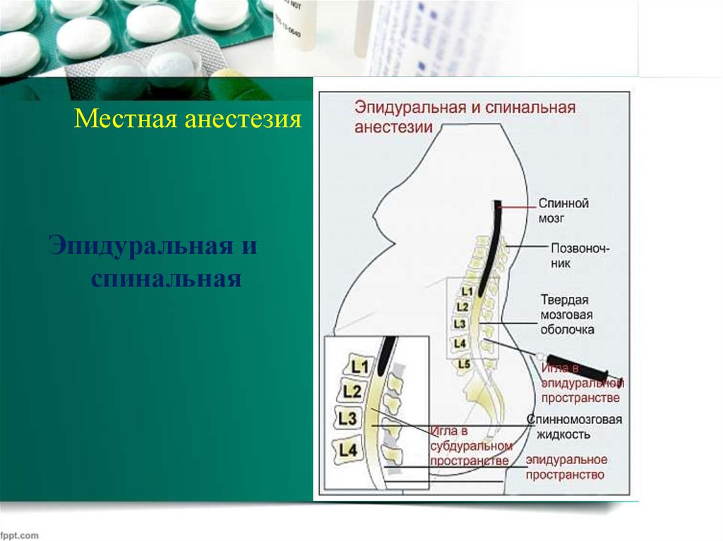 Спинномозговая анестезия. Разница спинальной и эпидуральной анестезии. Спиноэпидуральная анестезия. Эпидуральная анестезия методика. Проводниковая эпидуральная анестезия препараты.