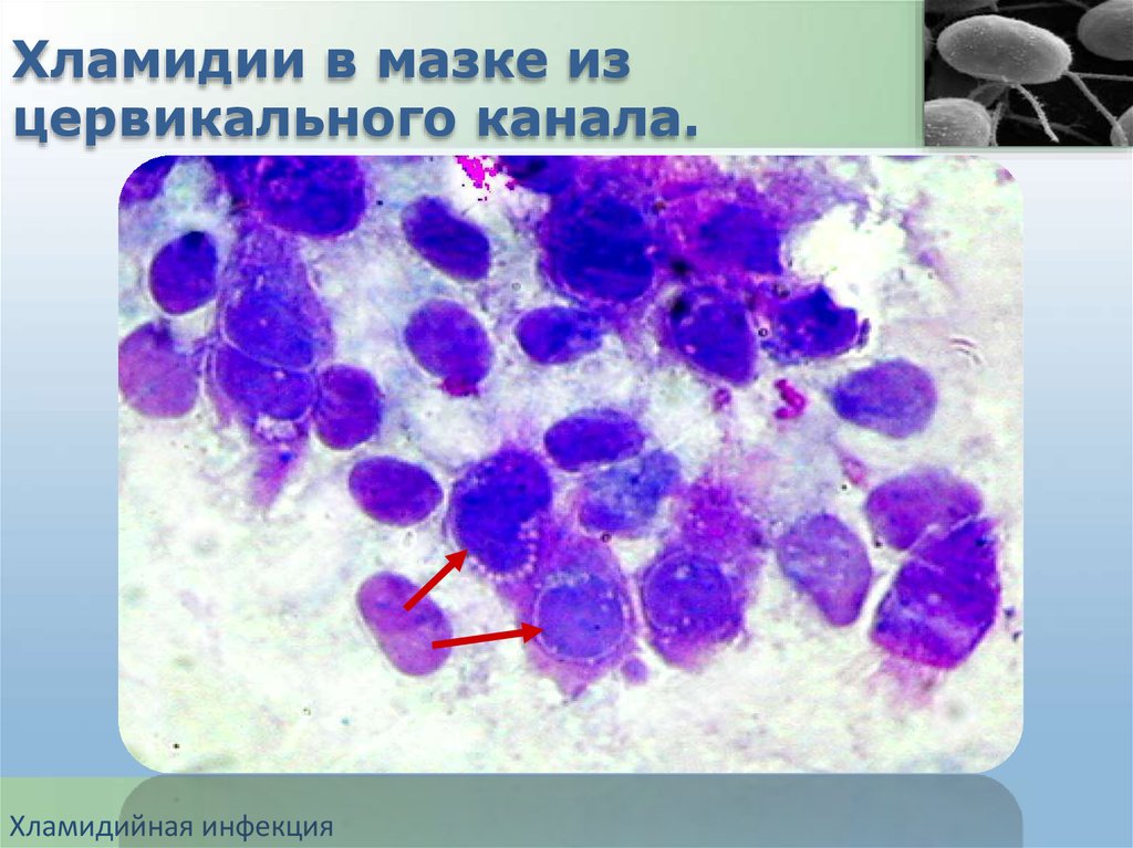 Хламидия берут. Урогенитальный хламидиоз микроскопия. Хламидиоз микроскопия мазка.