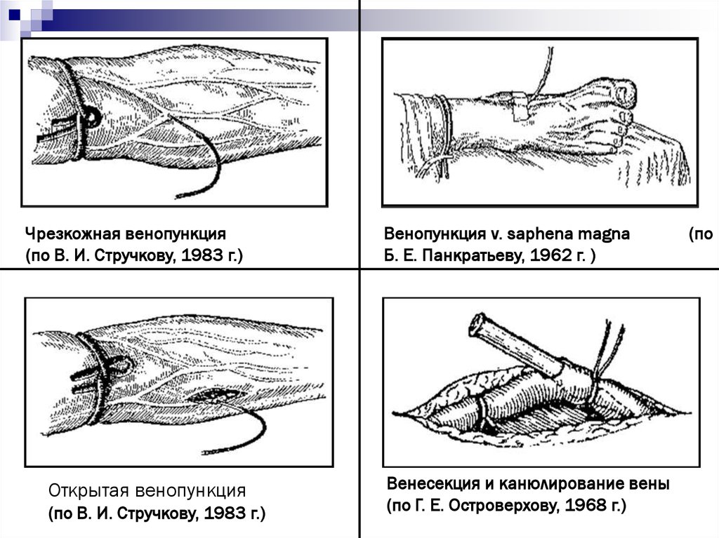 Переливание крови из вены в ягодицу схема