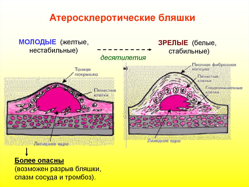 Можно ли убрать бляшку. Атеросклеротичечкая бляшки морфология. Атеросклероз строение бляшки. Атеросклеротическая бляшк. Структура атеросклеротической бляшки.