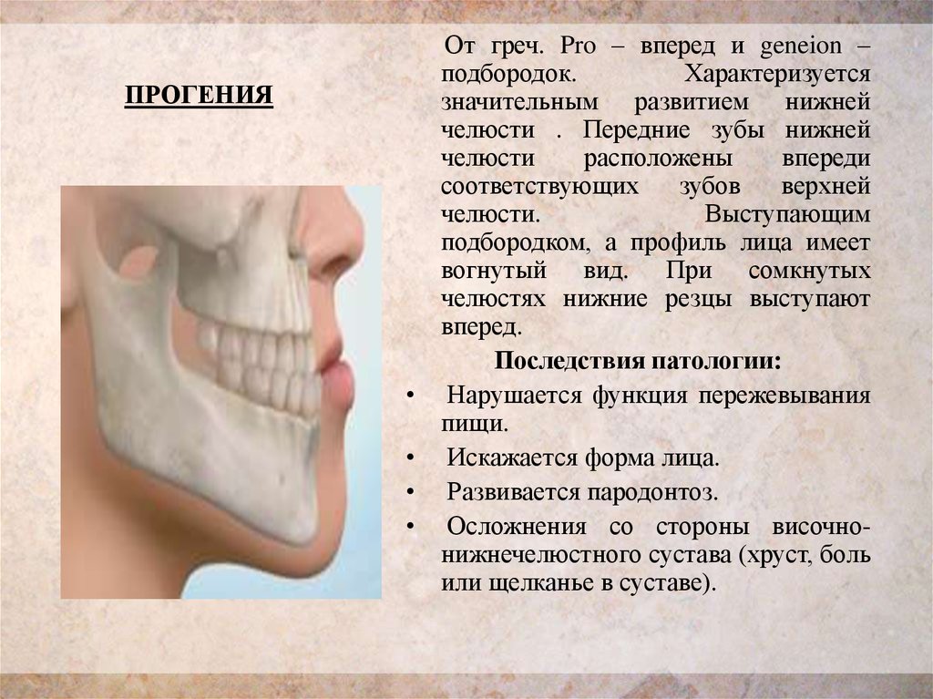 Прогения. Строение челюсти прогения прогнатия. Прикус прогенический мезиальный. Прогения нижней челюсти. Прогенический прикус кратко.