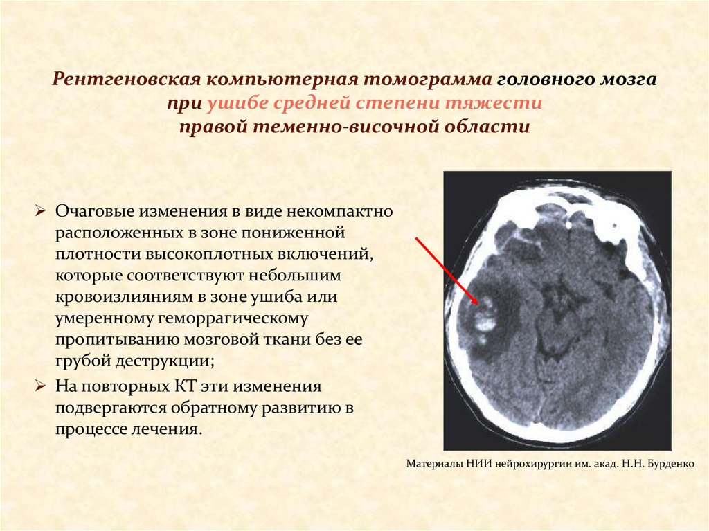 Очаговые изменения. Ушибы головного мозга степени тяжести кт. Ушиб головного мозга легкой степени кт. Кт головного мозга при контузии.