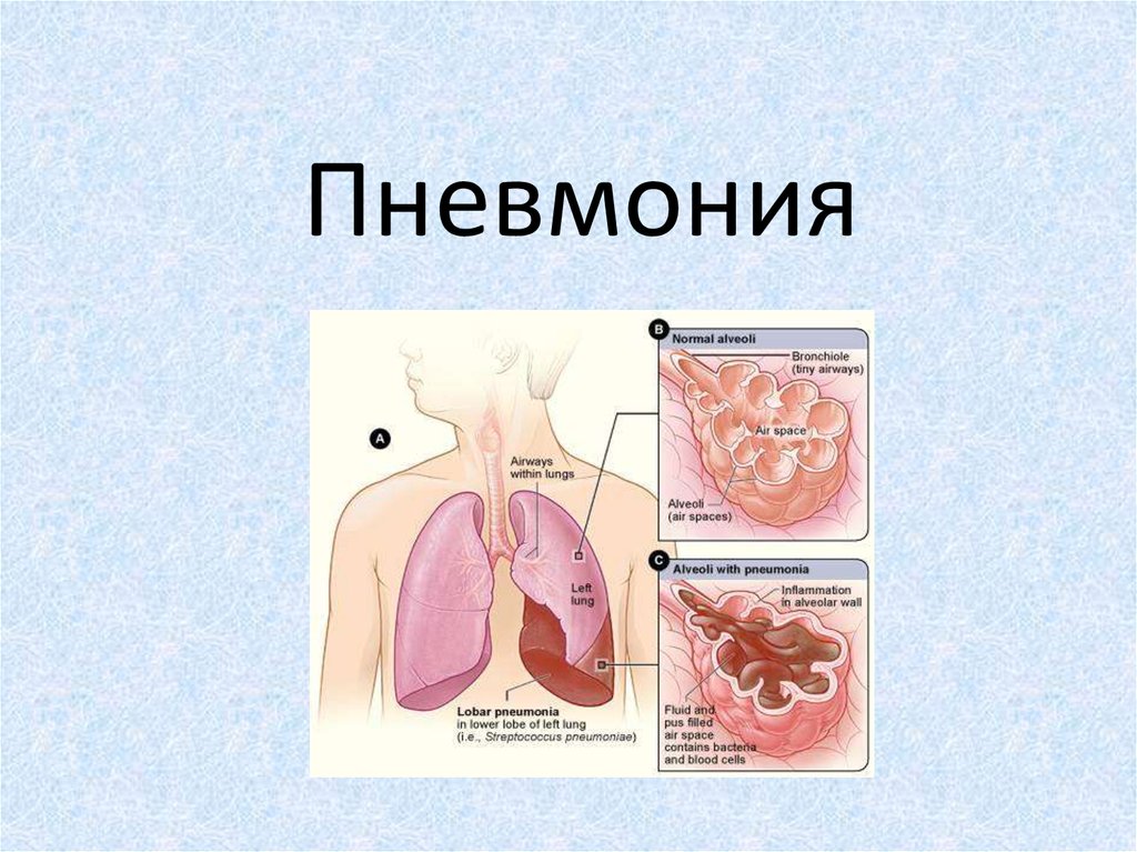 Пневмония презентация по терапии